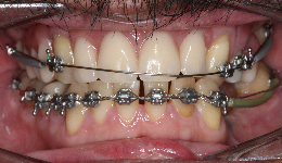 Braces to Align Teeth	